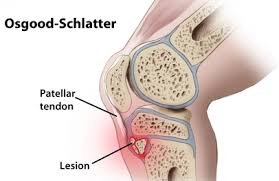 Osgood Schlatter Treatment in Delhi